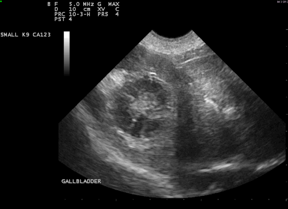 The gall bladder with a mucocoele The gall bladder with a mucocoele