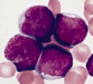 Lymphoblasts as seen under the microscope in a patient with Acute Lymphocytic Leukemia.