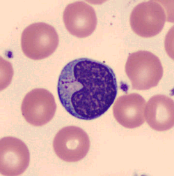 Mature Lymphocyte. In CLL, it is the sheer number of circulating cells rather than what they look like that makes the diagnosis.