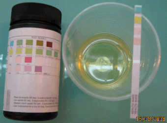 A urine dipstick measuring different chemical properties of the urine sample is part of the urinalysis.