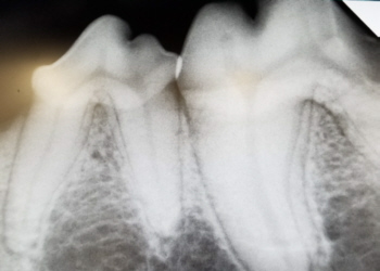 dental radiograph