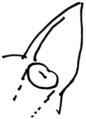 dotted lines indicate where incision is made dotted lines indicate where incision is made