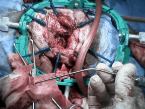 After the ear canal has been removed. A cone-shaped cavity remains. After the ear canal has been removed. A cone-shaped cavity remains.