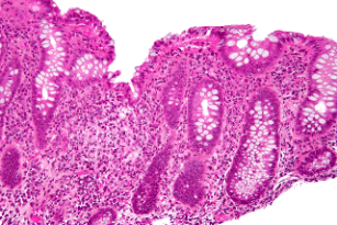 colon with lymphocytic infiltration 