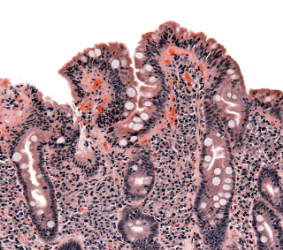 Small intestine heavily infiltrated by lymphocytes and affected by overgrowth of bacteria.