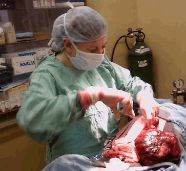 Dr. Brooks Removes Hepatocellular Carcinoma.