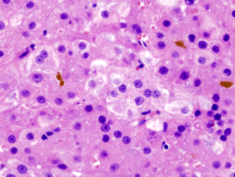 Biopsy sample of a liver with a hepatocellular carcinoma