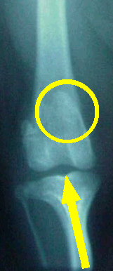 knee with medial luxating patella