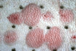 allergens are injected into the patient's skin allergens are injected into the patient's skin