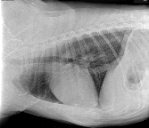 Pulmonary Thromboembolism