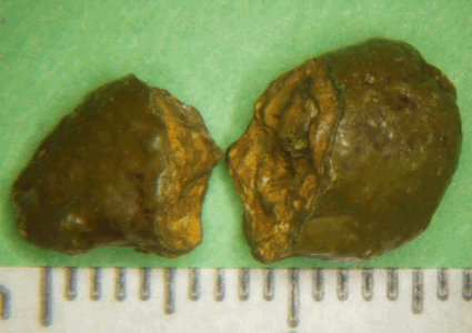 Xanthine Bladder Stones