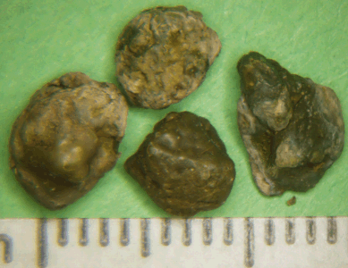 Xanthine Bladder Stones