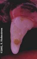 enamel hypoplasia