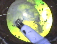 Eye receiving phacoemulsification.