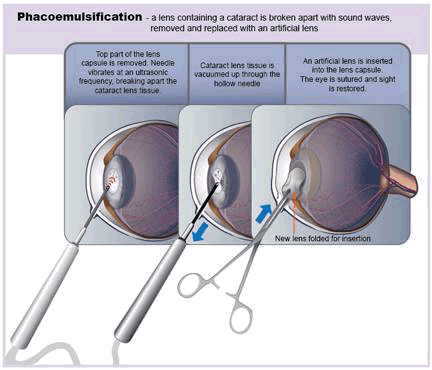 phacoemulsification