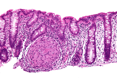 Colon with lymphocytic infiltration 