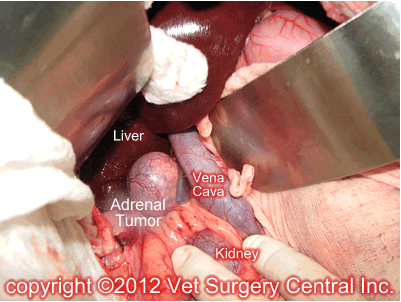 Surgical view of an adrenal tumor within the "Bermuda Triangle" of the abdomen.
