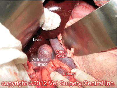 Surgical view of an adrenal tumor within the "Bermuda Triangle" of the abdomen. Surgical view of an adrenal tumor within the "Bermuda Triangle" of the abdomen.