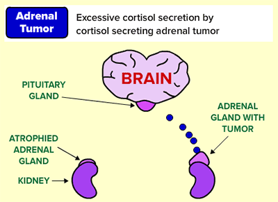 adrenal tumor