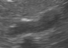 ultrasound image of an adrenal gland