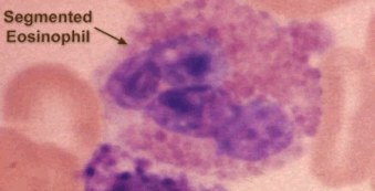 An eosinophil under the microscope. 