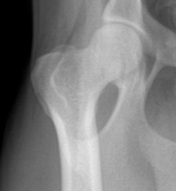 Normal Hip Xray