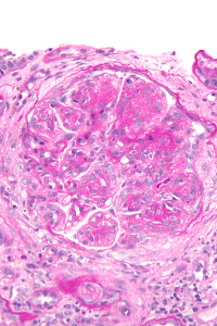 Kidney biopsy showing an inflamed glomerular tuft