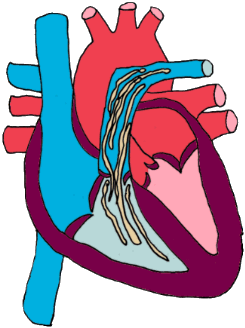 A bunch of heartworms hanging out in the pulmonary artery A bunch of heartworms hanging out in the pulmonary artery