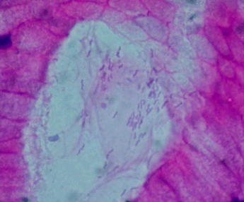 small purple "sticks" are Helicobacter organisms