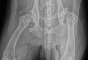 Severe hip Dysplasia in both hips.