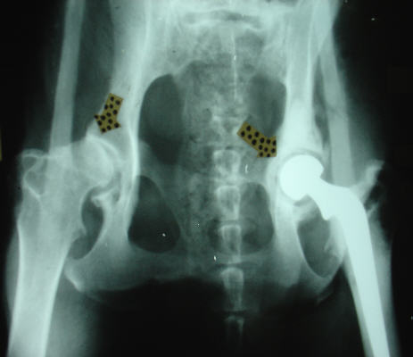 The hip on the right has been replaced with a prosthesis. 
