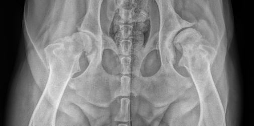 After years of walking on dysplastic hips, severe hip arthritis is present in this patient.