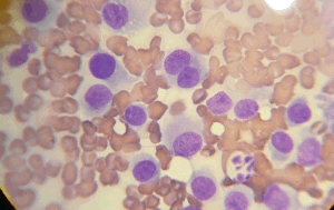 Canine Histiocytoma Cytology