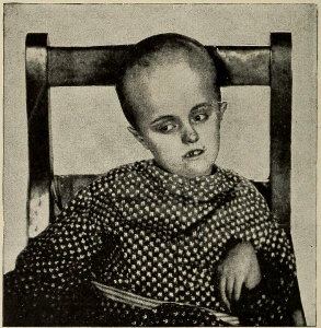 Child with Hydrocephalus