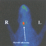 Scan of hyperthyroid cat, showing enlarged thyroid glands