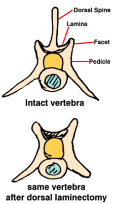 Graphic showing entire top of vertebra has been removed to make room for swollen spinal cord.