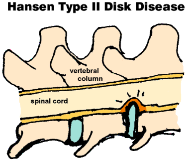 Graphic showing Type II Disk Disease