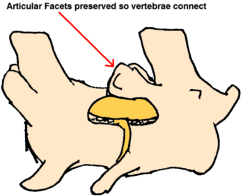 “Pedicular” bone is removed from the vertebrae to create room for the spinal cord but the articular facets are preserved above.