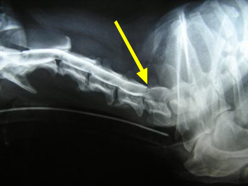 Myelogram showing dye column obstructed between the 5th and 6th cervical vertebrae