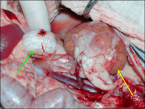The recipient has an additional kidney added in. The new kidney is on the right (yellow arrow) while the original kidney (green arrow) is on the left.