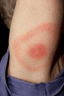 Erythema migrans: 