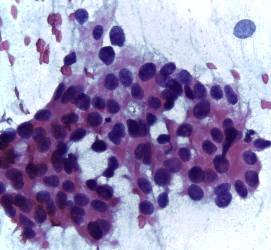 Needle aspirate of a mammary adenocarcinoma.