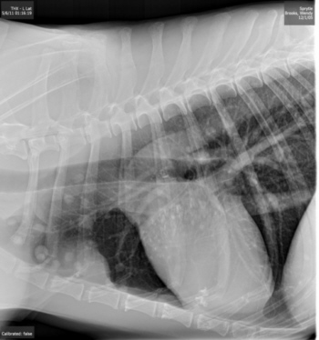 Chest film towards the end of his life. Tumor spread shows as "polka dots" spread over the lung fields