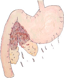 Image Showing Swollen, inflamed pancreas with areas of hemorrhage