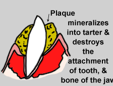 illustration of severe tartar buildup 