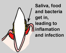 illustration showing plaque collecting in gingival sulcus illustration showing plaque collecting in gingival sulcus
