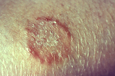 picture of human ringworm lesion
