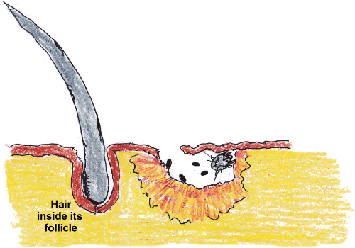 Female mite burrowing into the skin generating inflammation as she digs.