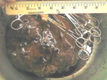 Spleen with Ruler Spleen with Ruler