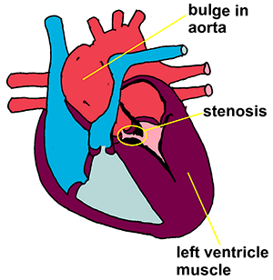 heart with SAS